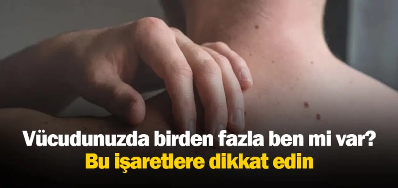 Vücudunuzda birden fazla ben mi var? Bu işaretlere dikkat edin