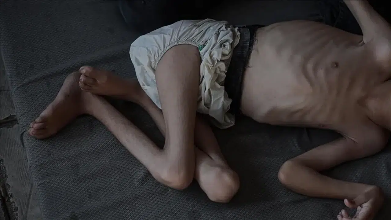 Gazze'de açlık kabusu: 367 kişi hayatını kaybetti
