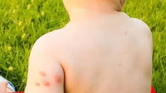 Sizi hangi böceğin ısırdığını merak ediyorsanız bu haber tam size göre!