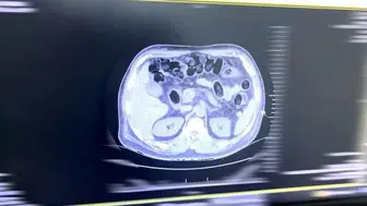 Midesinde 160 parça halinde uyuşturucuyla yakalandı