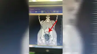 Midesinden 472 gram metamfetamin çıktı