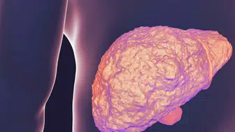 Karaciğer yağlanması sirozu tetikliyor