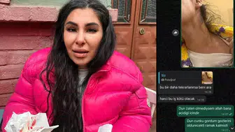 İlişkisini bitirmek istedi darbedilip burnu kırıldı: Yaşamak istiyorum