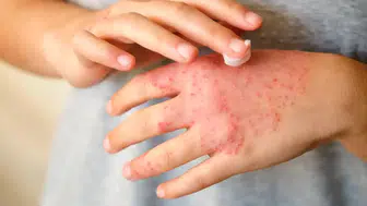 Egzama hakkında ezber bozan gerçekler