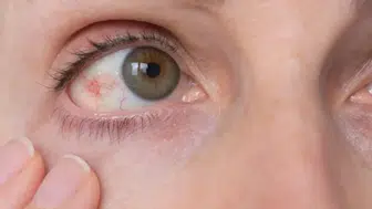 Göz tansiyonuna dikkat: Tedavi edilmezse kalıcı körlüğe yol açıyor