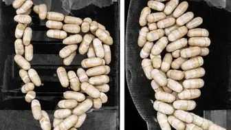 2 şüphelinin midesinden 127 kapsül uyuşturucu çıktı