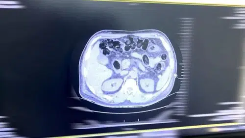 Midesinde 160 parça halinde uyuşturucuyla yakalandı