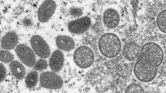 Maymun çiçeği virüsü alarmı: ABD'ye de sıçradı
