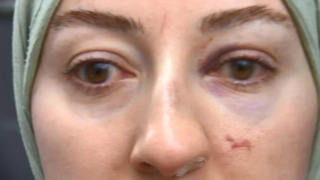 Sultangazide yol verme kavgasını çekmek isteyen kadın darbedildi; 2 yaralı